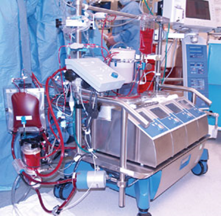 A heart-lung machine. The machine temporarily takes over the function of the heart and lungs during open-heart surgery by maintaining the circulation of blood and oxygen throughout the body.